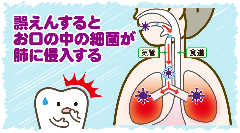誤えんするとお口の中の最近が肺に侵入する