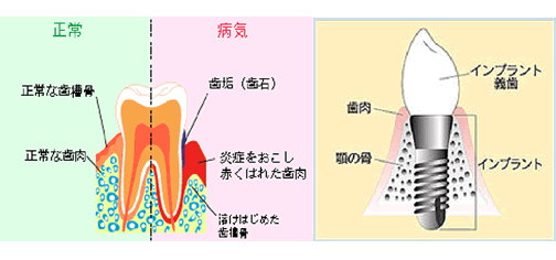 インプラントの図