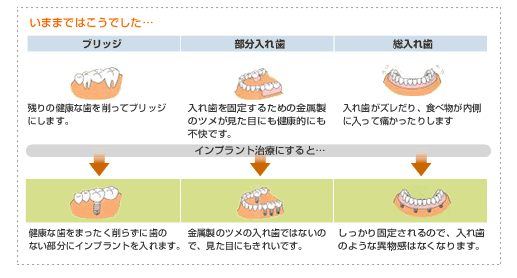 ブリッジ、部分入れ歯、総入れ歯との違いについて